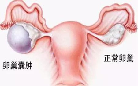 卵巢囊腫的十個征兆，卵巢囊腫的十個征兆解析