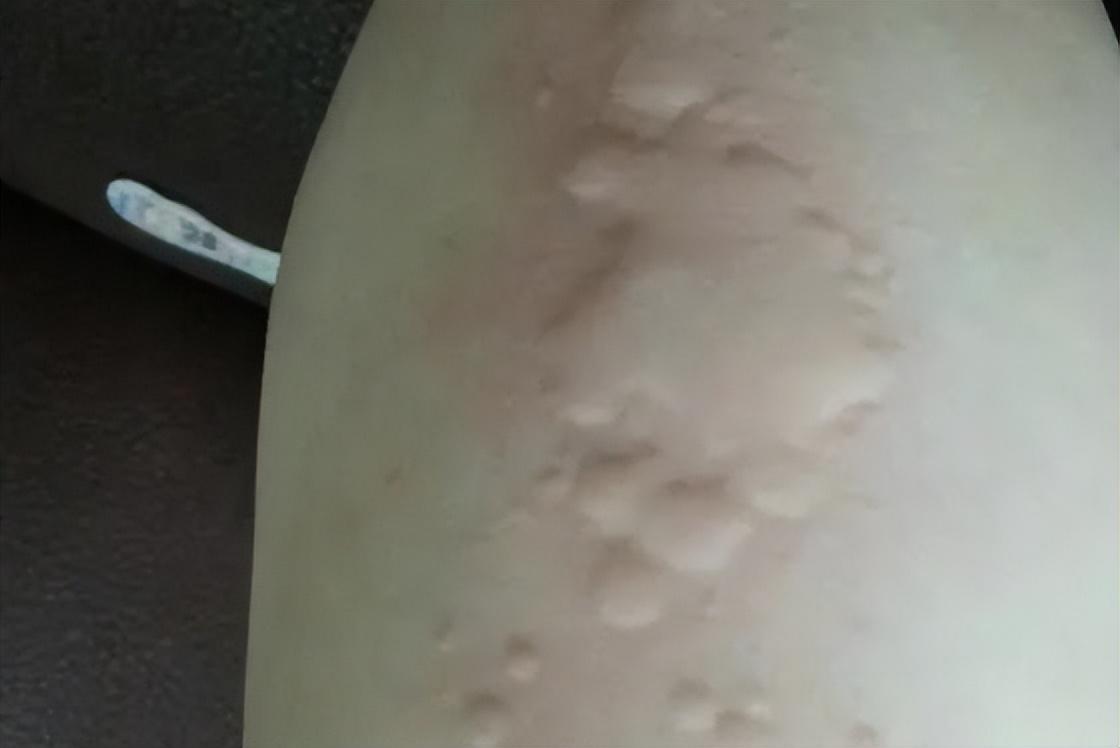 大蒜，治癬的最好的偏方，大蒜，治癬最佳偏方揭秘