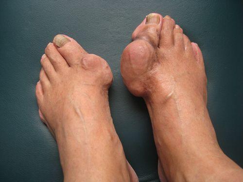 尿酸高最快的恢復(fù)方法，全面解析與行動(dòng)指南，尿酸高患者必看，全面解析與行動(dòng)指南，快速恢復(fù)健康之道