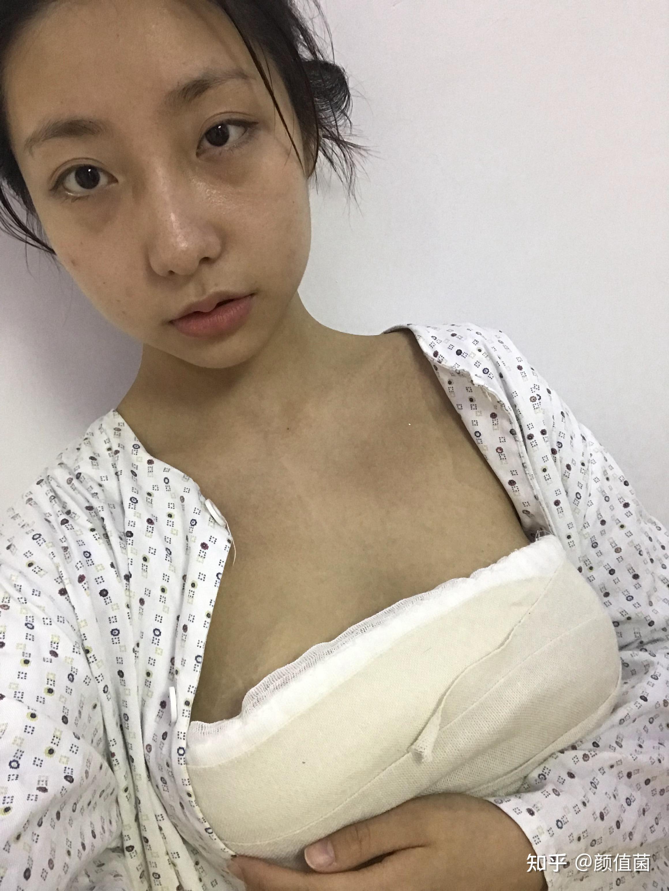 自體脂肪隆胸的真實(shí)經(jīng)歷分享，自體脂肪隆胸的真實(shí)體驗(yàn)分享