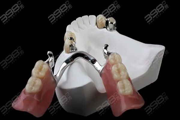 鑲一顆牙大概需要多少錢——全面解析鑲牙費用因素，鑲一顆牙的費用解析，全面探討鑲牙費用因素及大概價格