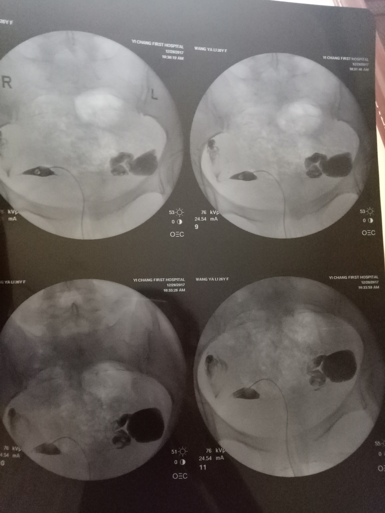 造影第二個月懷孕，機會與準備，造影后第二個月懷孕的機會與準備事項