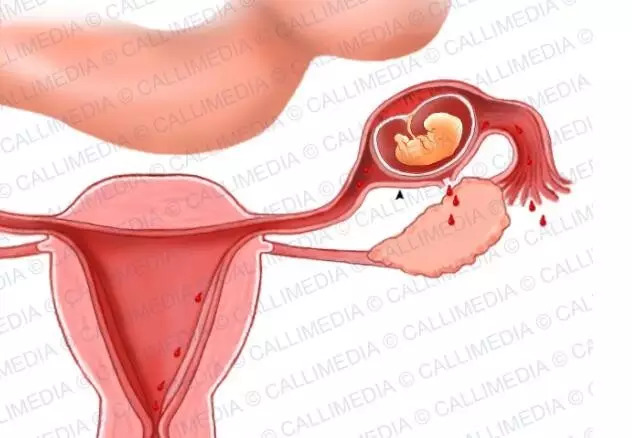 宮外孕20天最明顯的征兆，宮外孕20天的明顯征兆，早期識別與應(yīng)對的關(guān)鍵時(shí)刻