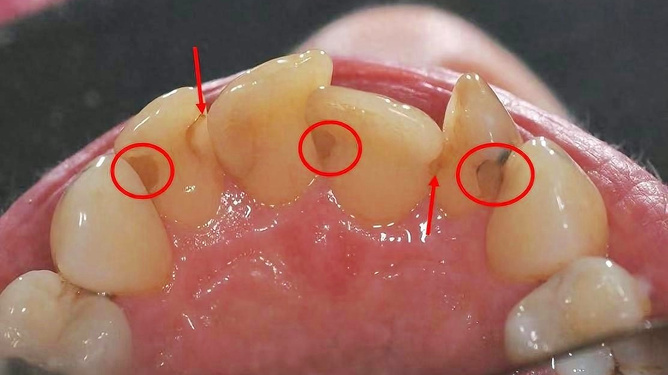 牙結(jié)石怎么去除小竅門，牙結(jié)石去除小妙招分享