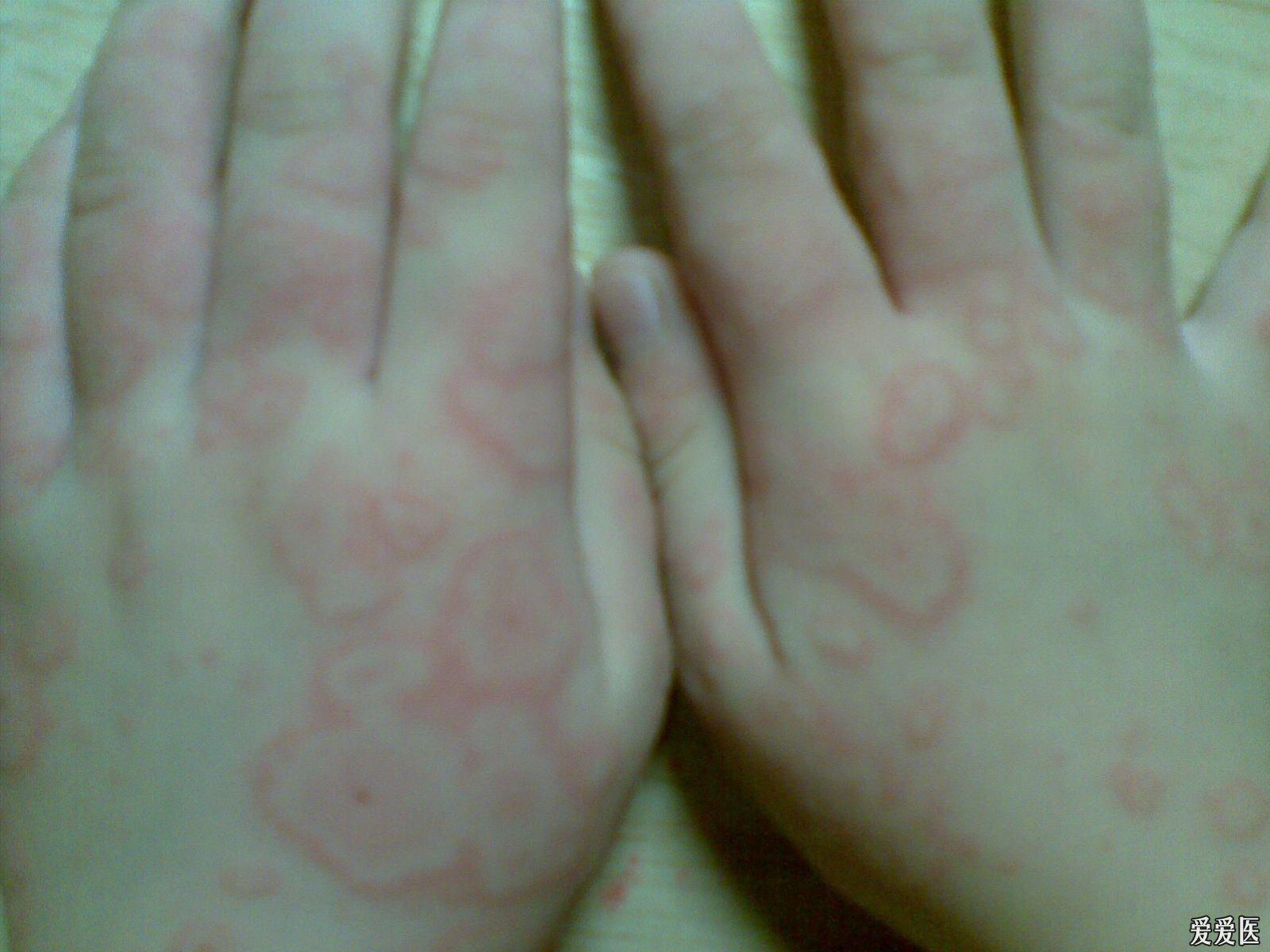 關(guān)于螨蟲過敏圖片與澳彩資料的查詢，來自94848.cσm的詳盡資源，螨蟲過敏圖片與澳彩資料查詢，詳盡資源來自94848.cσm