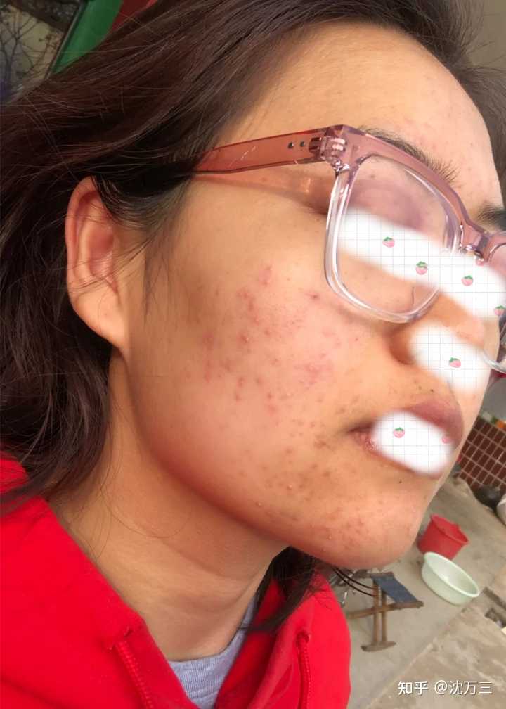 消除痤瘡留下的紅色痘印的有效方法，消除紅色痘印，痤瘡后的護膚秘訣