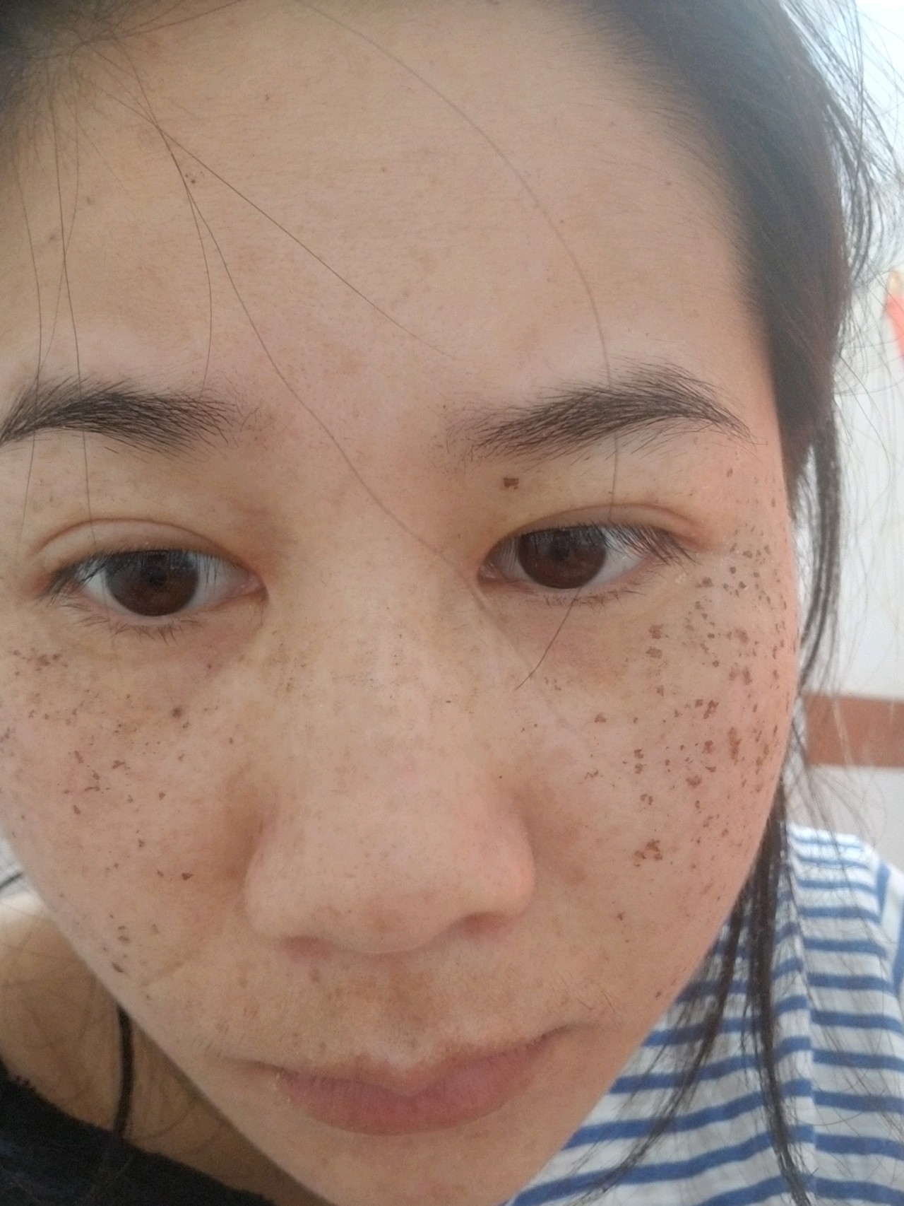 激光祛斑后的15天，見(jiàn)證肌膚煥變的瞬間，激光祛斑后15天，肌膚煥新瞬間見(jiàn)證