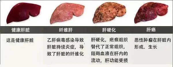 我的肝硬化三十年，經(jīng)歷、挑戰(zhàn)與希望，肝硬化三十年，我的經(jīng)歷、挑戰(zhàn)與希望的歷程