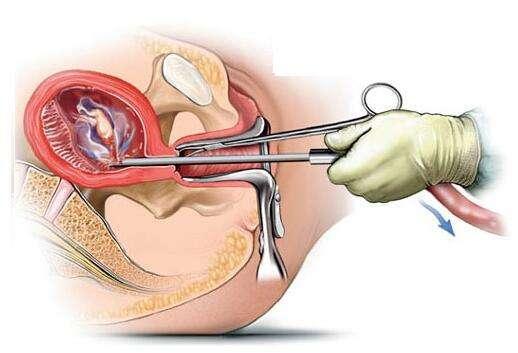 流產(chǎn)最小的傷害是哪一種，探討不同流產(chǎn)方式的利弊與選擇策略，探討不同流產(chǎn)方式的利弊，尋找最小傷害的選擇策略