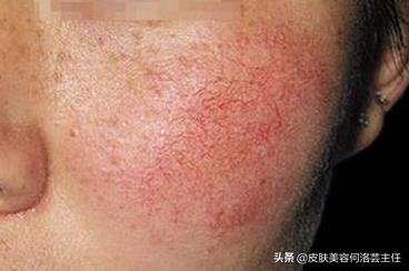 臉上有紅血絲怎么辦？全面解析治療方法，全面解析臉上紅血絲的治療方法