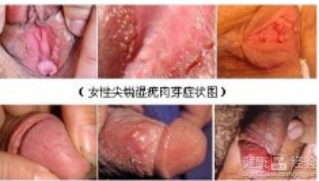 男性初期小疣體圖片，了解、識別與應(yīng)對，男性初期小疣體圖片詳解，識別、理解與應(yīng)對方法