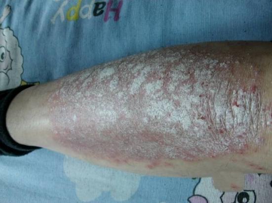 銀屑病初期癥狀圖片解析，了解銀屑病從初始階段開始，銀屑病初期癥狀詳解，圖片解析助你早期識別銀屑病