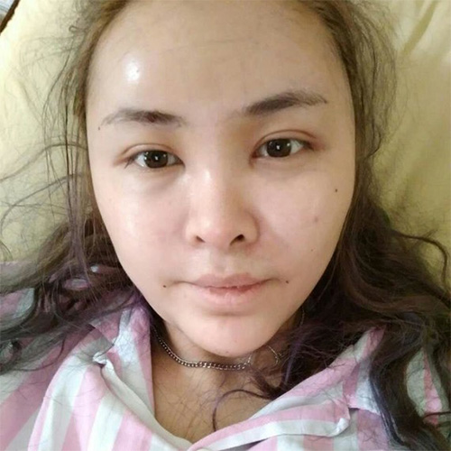 脂肪填充五年后可能出現(xiàn)的后遺癥，脂肪填充五年后可能出現(xiàn)的后遺癥及預防措施