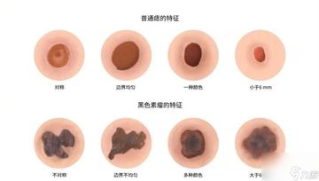 正常痣與黑色素瘤圖片，了解二者的區(qū)別與識別方法，正常痣與黑色素瘤圖片對比，區(qū)分與識別方法指南