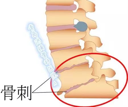 骨刺的最佳治療方法，骨刺的最佳治療方法解析
