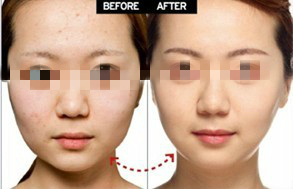 全面解析，瘦臉針價(jià)格及其相關(guān)因素，全面解析瘦臉針價(jià)格及其相關(guān)影響因素