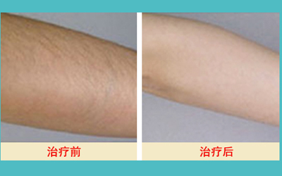 激光脫毛的價(jià)格解析，多少錢(qián)才能擁有絲滑肌膚？，激光脫毛價(jià)格詳解，多少錢(qián)能擁有絲滑肌膚？