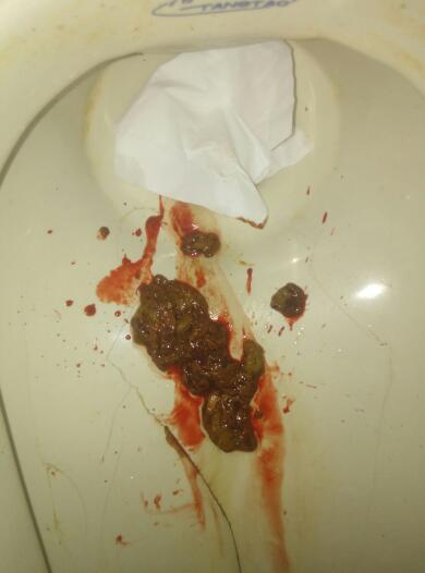 上大號(hào)拉出血怎么回事——解析便血的可能原因與應(yīng)對(duì)措施，解析，大便出血的原因及應(yīng)對(duì)措施