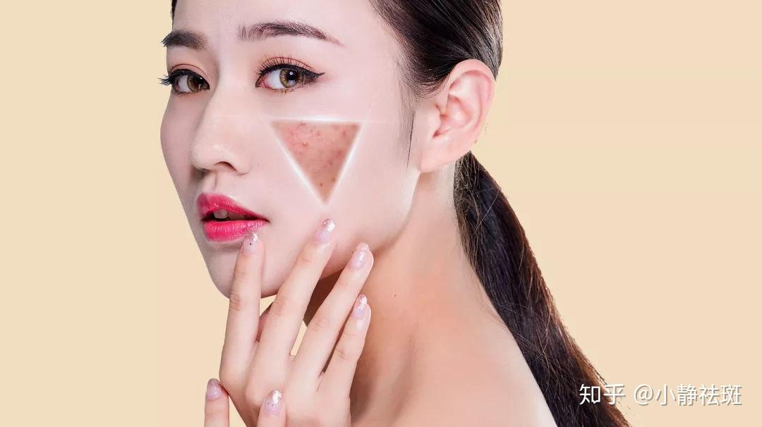如何有效去除臉上的雀斑，最佳方法全解析，全面解析，如何有效去除臉上雀斑的方法