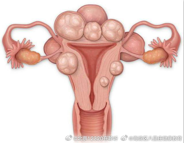 子宮肌瘤的最佳治療方法，全面解析與指導(dǎo)，子宮肌瘤的最佳治療方法詳解與指導(dǎo)手冊(cè)